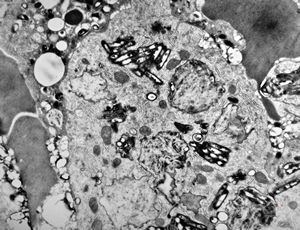 Whipple disease Whipple disease